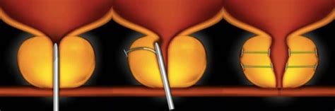 HoLEP | minimally invasive prostate surgery