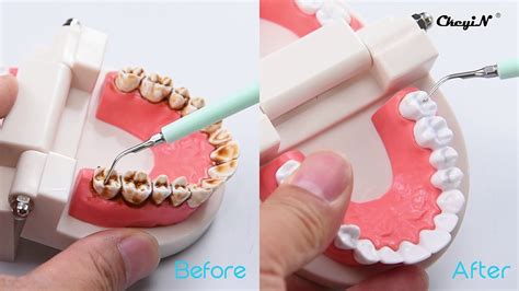 Dental Cleaning Teeth Tools at Emanuel Keller blog