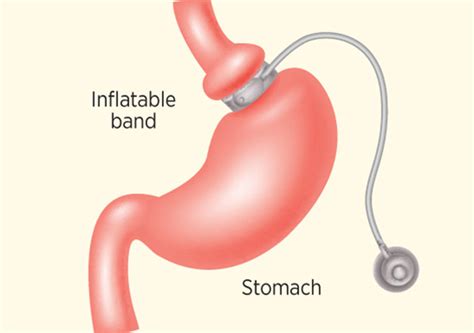 Gastric Lap Band: A Non-Surgical Approach to Weight Loss - Jas-Travel