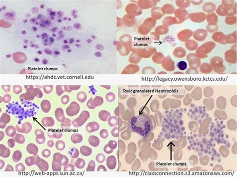 Haematology in a NutShell: Platelet Clumps