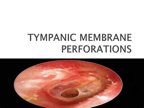 SOLUTION: Tympanic membrane perforations - Studypool