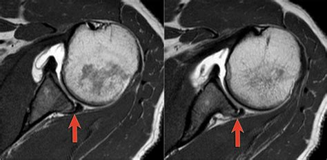 Bankart Lesion Mri