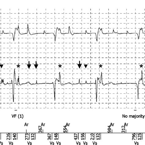 Accelerated idioventricular rhythm at a rate of approximately 80 beats ...