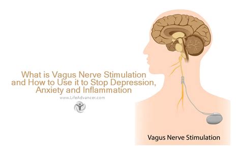 What Is Vagus Nerve Stimulation and How to Use It to Stop Depression ...