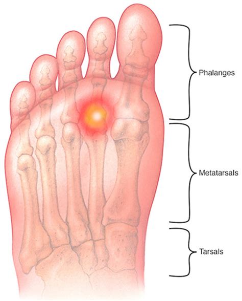 Metatarsalgia - Causes, Symptoms, Treatment, Home Remedies