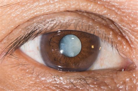 These Eye Drops Can Treat Cataract Without A Surgery