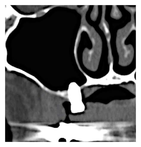 CT scan 8 months after sinus augmentation in the first stage showed ...