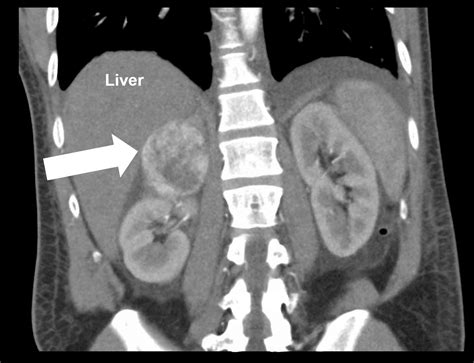 Benign Adrenal Gland Tumors