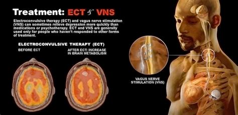 Vagus Nerve Stimulation Side Effects