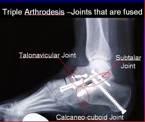 Triple Arthrodesis - FootEducation