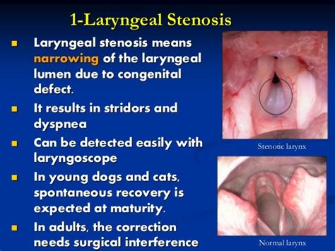 Laryngeal diseases