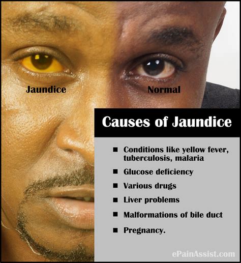 Home Remedies For Jaundice In Adults