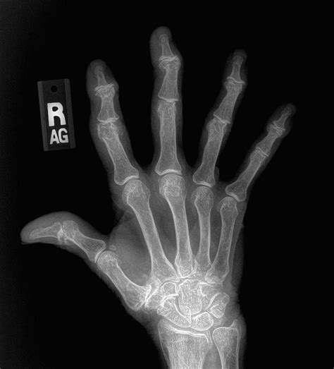 What does hand arthritis look like on x-ray? - John Erickson, MD