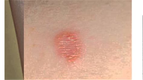 fungal skin rash - pictures, photos