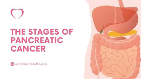 The Stages of Pancreatic Cancer – Healthsoothe: Health And Dental Care