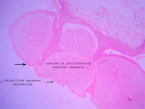 Capillary hemangioma – Histopathology.guru