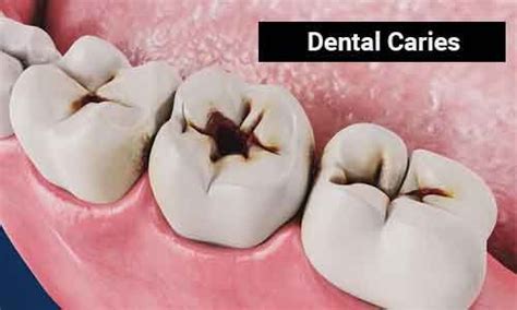 Dental Caries- Standard Treatment Guidelines