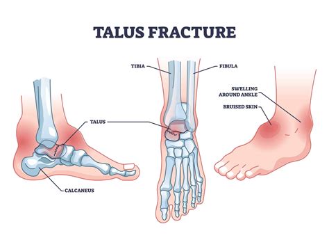 Talus Fracture: How to treat a Talus Fracture by a Foot Specialist