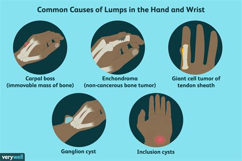 Lump on Wrist or Hand: Cysts, Tumors, and Other Causes