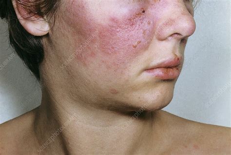 Lupus erythematosus on the face - Stock Image - C013/1028 - Science ...