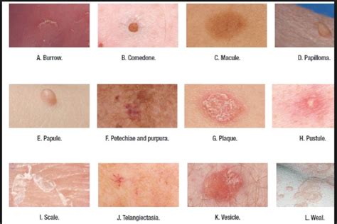 Skin Lesion Types for Nursing Students | Dermatology nurse, Skin ...