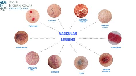 Vascular Lesions | Doç.Dr. Ekrem Civas - Dermatology