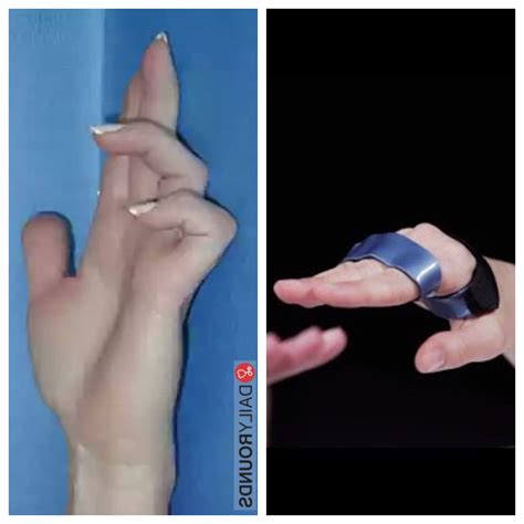 Pin by Brenda73 on Splints | Hand therapy, Occupational therapy, Ulnar ...