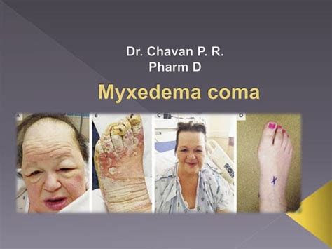 Management of Myxedema coma