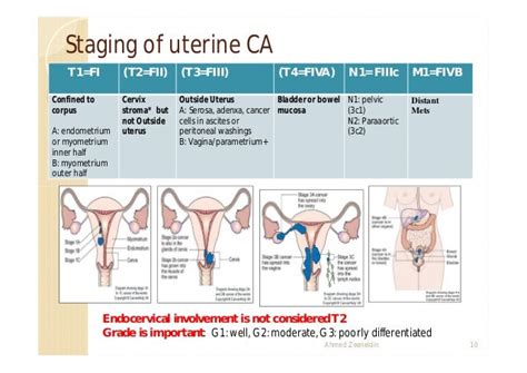 Uterine cancer 10 2011