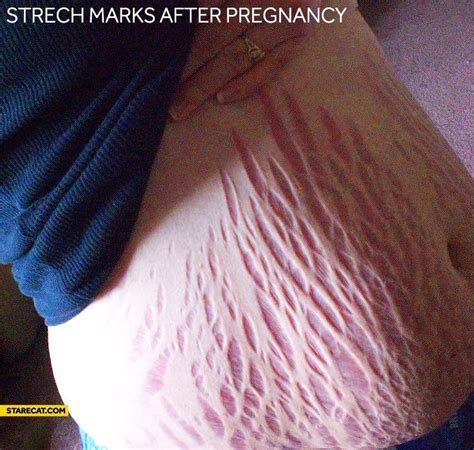 Stretch Marks After Pregnancy : MakeMeSuffer