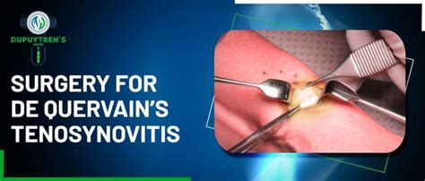 De Quervain’s Tenosynovitis Surgical Treatment & Its Risks