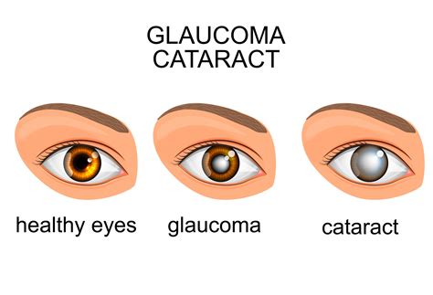 Signs and Symptoms of Cataracts | Eye Diseases | Eye Health