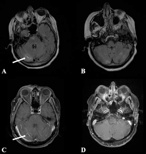 Balamuthia mandrillaris imaging: Ring-enhancing lesions on MRI of the ...