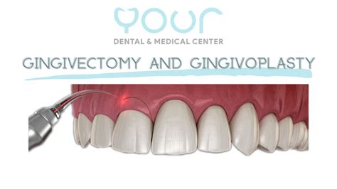 Gingivectomy and Gingivoplasty