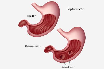 Curling's Ulcer Signs and Symptoms, Causes, Diagnosis, Treatment ...