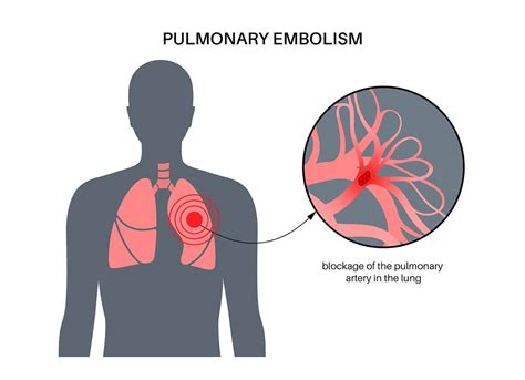 3 Symptoms of Pulmonary Embolism - Elite Hospital Kingwood