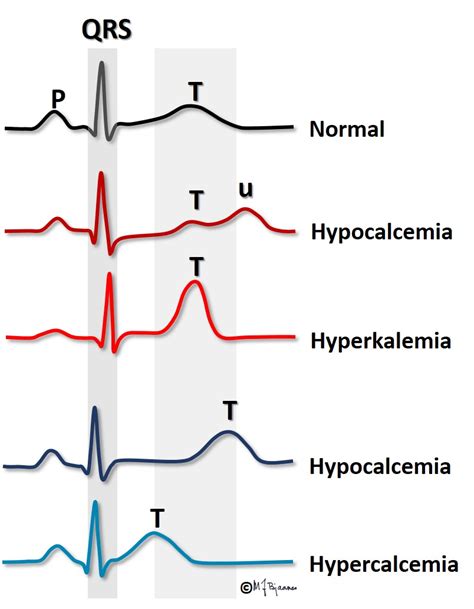 Hypokalemia Ecg