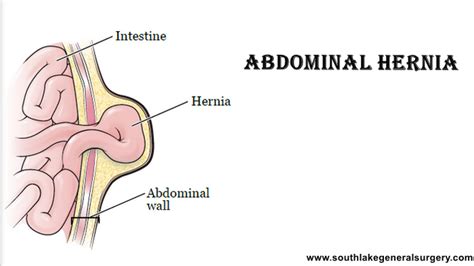 Abdominal Hernia- Symptoms, Diagnosis and Treatment | Southlake Texas