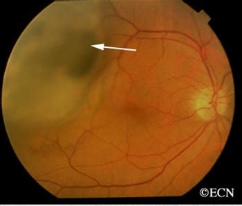 Choroidal Melanoma » New York Eye Cancer Center