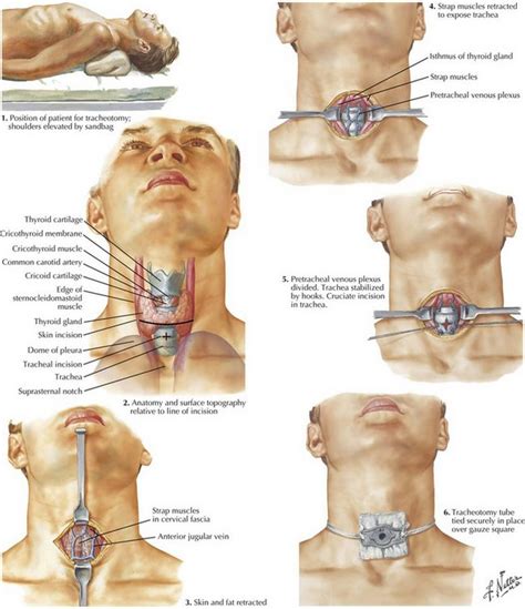 Tracheostomy Procedure Steps