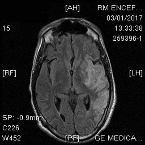 Brain MRI shows an acute infarction in the left hemisphere. | Download ...