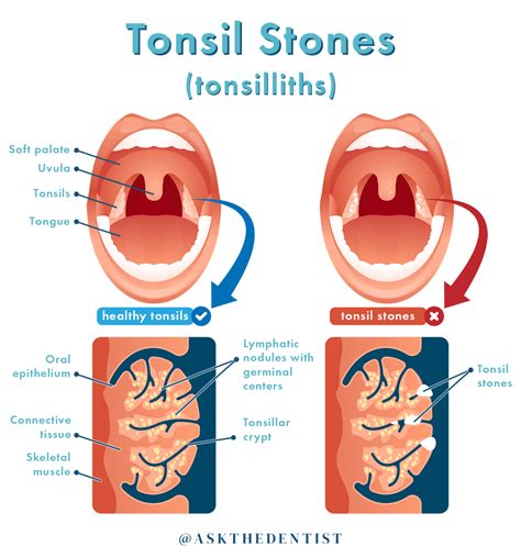 Tonsil Stones: Symptoms, Causes, and How to Remove - Ask the Dentist