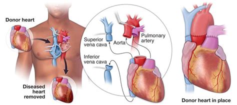 Heart Transplant | Temple Health