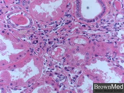 Pathology Outlines - Chronic pyelonephritis