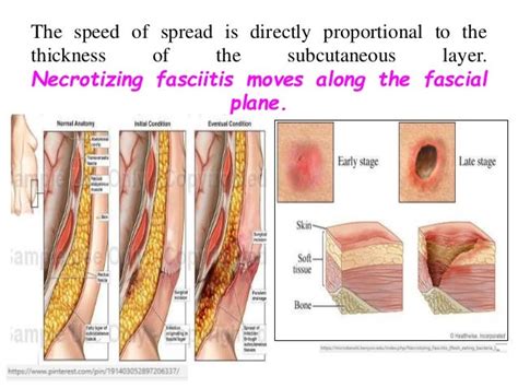 Necrotizing fasciitis