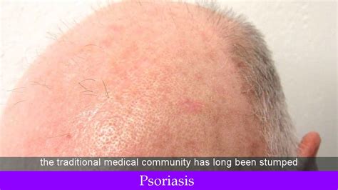 Psoriasis Genital Cure - YouTube