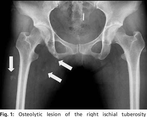 [PDF] Ischial Tuberosity Tuberculosis : An Unusual Location and ...