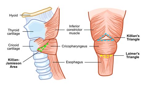 Zenker’s Diverticulum