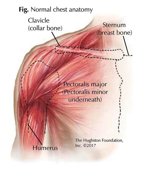 Chest Muscle Injuries: Strains and Tears of the Pectoralis Major ...