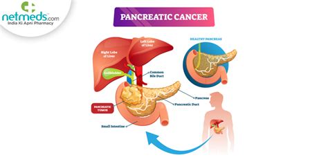 Symptoms Of Stage 4 Pancreatic Cancer